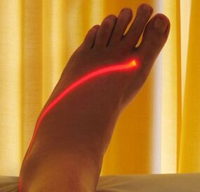 lasersko liječenje proširenih vena na nogama