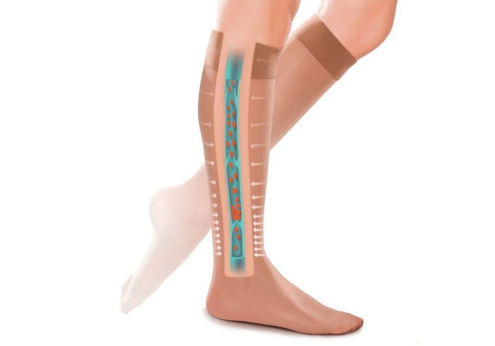 učinak kompresijskih čarapa na noge s proširenim venama