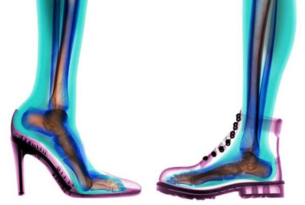udobne i neudobne cipele za prevenciju proširenih vena