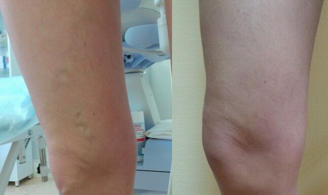 nogu prije i poslije liječenja retikularnih proširenih vena