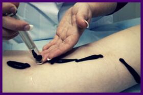 Postupak za liječenje proširenih vena pijavicama (hirudoterapija)