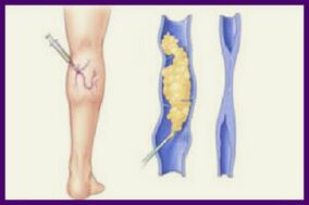 Skleroterapija je popularna metoda rješavanja proširenih vena na nogama