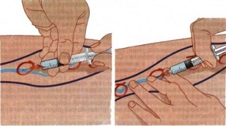 metode liječenja proširenih vena