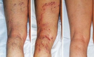 simptomi proširenih vena na nogama