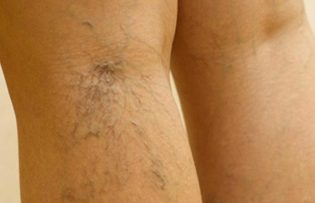 liječenje proširene vene na nogama