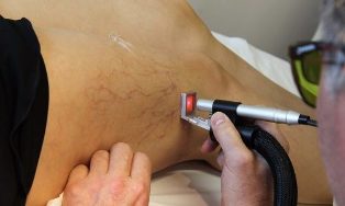 tretman laserom proširene vene