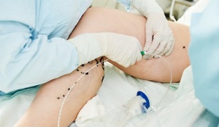 metode liječenja proširenih vena na nogama kod žena