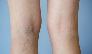znakovi proširenih vena na nogama kod žena